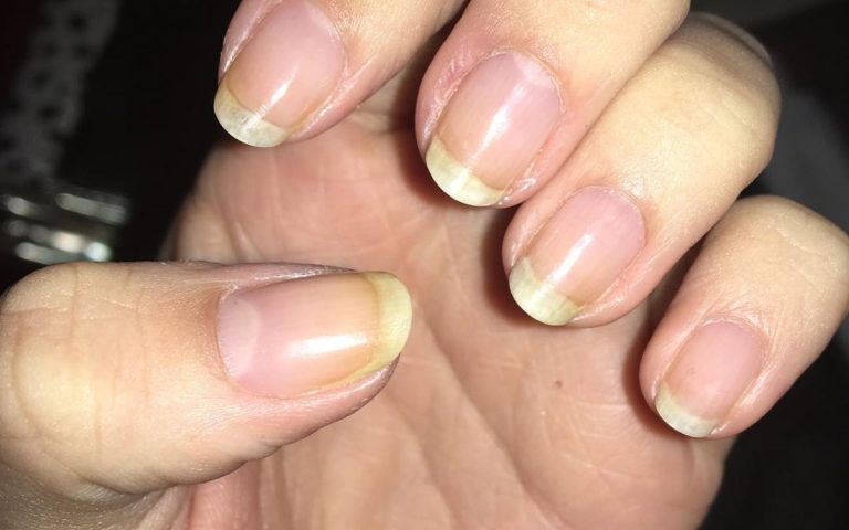 startling-reasons-why-your-nails-turn-yellow-polish-and-pearls